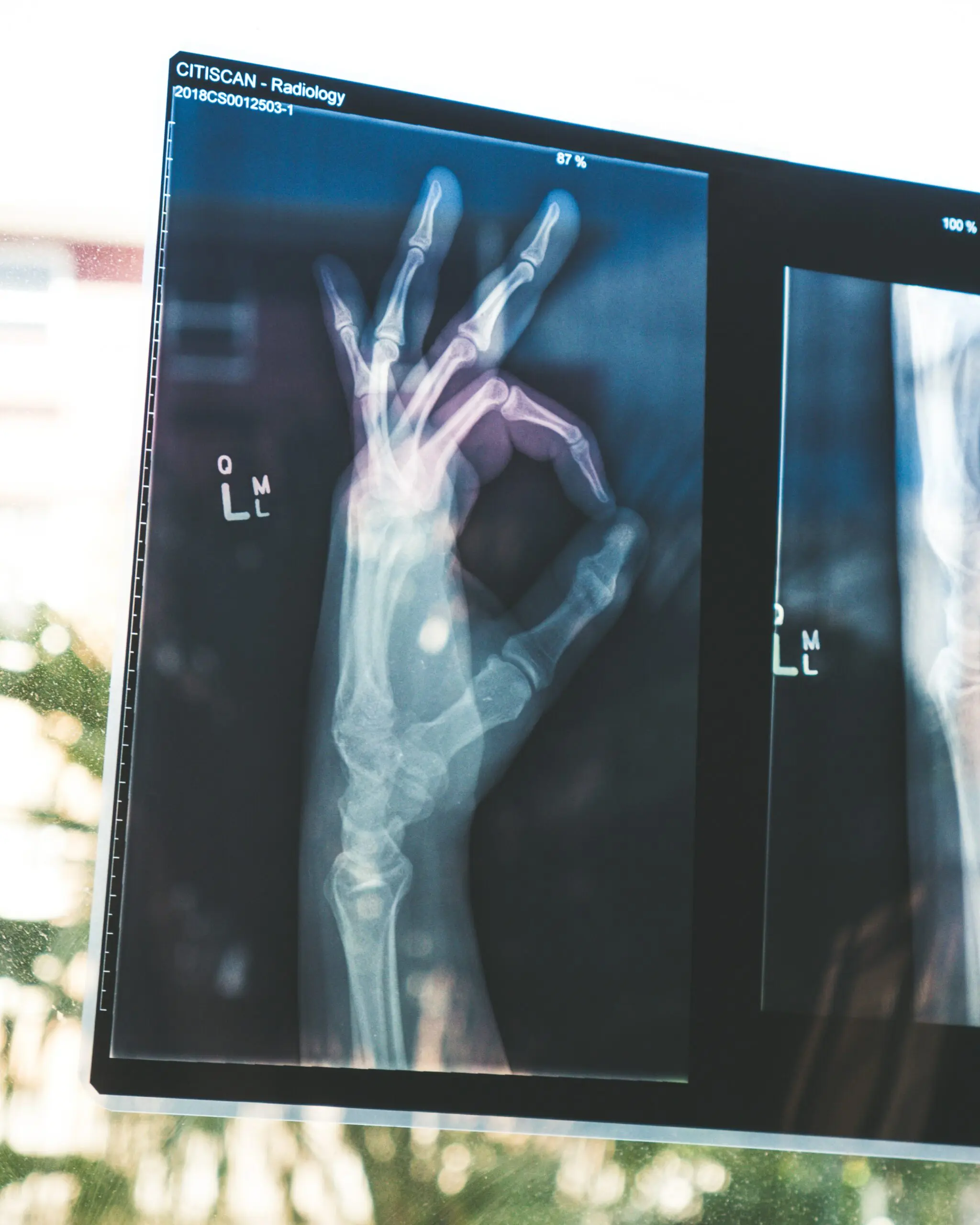 this-world-osteoporosis-day-remember-to-love-your-bones