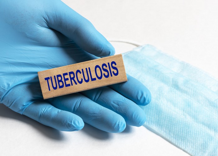 sound-the-alarm:-we-are-failing-to-meet-targets-to-beat-tb-but-khayelitsha’s-care-model-during-covid-19-shows-exactly-how-it-should-be-done
